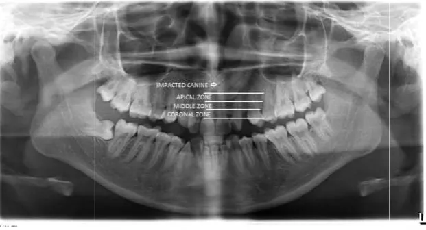 Figure 1. The lines and measurements drawn on panoramic radiograph for evaluating Katsnelson’s techniqueFigure 1