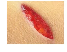Fig 2: Image Samples (a) Stabbed Wound of Double-edge knife (b) Accidental Wound 