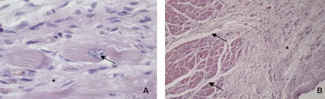 Figure 4. Histopathology slides stained with hematoxylin and eosin shows fibrosis (*) proliferation of collagen fibers (*) and fibrous connective tissue (arrow) in (B) (×40)
