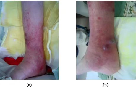 Figure 1. to the medial aspect of the right leg. Erythema with multi-ple, small subcutaneous hemorrhages were observed; (b) Medial aspect of the right leg