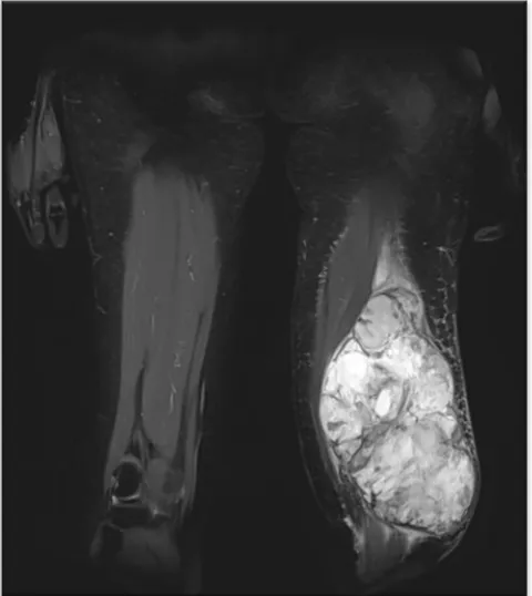 Figure 5. Wide excision surgery of the tumor mass on the left thigh. 