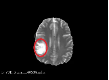 Fig. 1: MRI Brain Scan showing brain tumor.