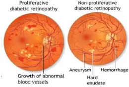 Figure 1: Retinal images with NPDR and PDR [2] 