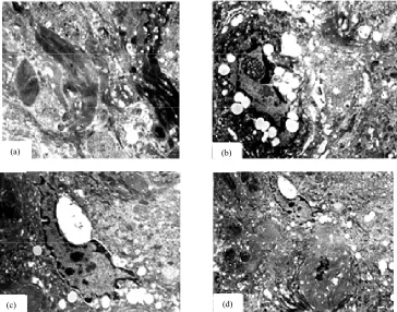 Figure 2. Histology showed hyperkeratosis, parakeratosis, follicular plugging, irregular acanthosis, acantholytic kera- tinocytes forming corp ronds and corp grains