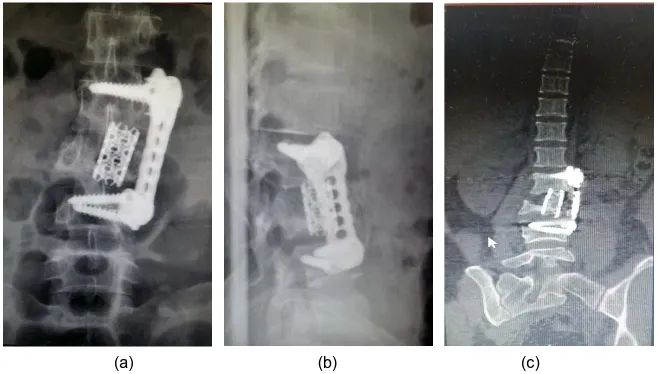 Figure 11. Pre operative CT spine sagital (a), axial (b) and coronal (c) views. 