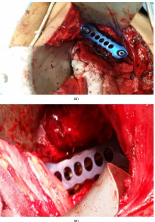 Figure 1. (a) Intra operative image showing corpectomy of L2 was done with preparation before instrumentation; (b) Expandable cage loaded with bone graft; (c) Mesh loaded with bone graft screws applied at L4 and L3 body; (d) Anterior plate with set screw a