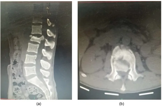 Figure 5. Pre operative CT spine sagital (a) and axial (b) views. 