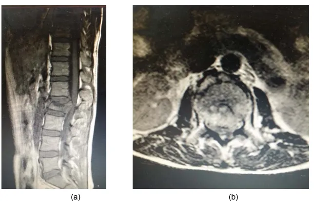 Figure 6. Pre operative MRI spine sagital (a) and axial (b) views.  