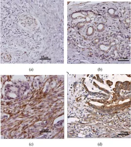 Figure 1. The expression of SPARC detected by immunohistochemistry cancer positive, stromal expression negative; (c) SPARC expression: cancer negative, stromal expression negative; (b) SPARC expression: in pancreatic ductal adenocarcinomas samples