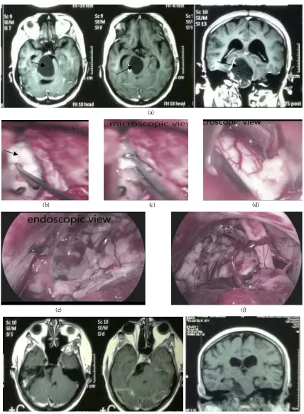 Figure 1. (a) MRI brain with contrast (axial and coronal views) showed right CPA epidermoid tumor (The arrowheads); (b) Mi-croscopic view of dissection of the tumor (The arrowhead) in the CPA; (c) Microscopic view of excision of the tumor using the mor; (f