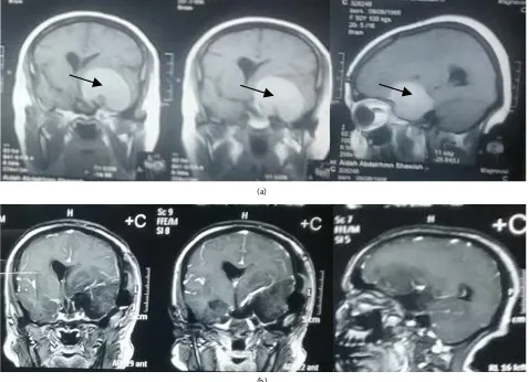 Figure 2. MRI brain with contrast (coronal and sagittal views) showed left medial sphenoid wing meningioma: (a) Pre-operative (The arrowheads); (b) Post-operative excision through endoscope assisted microscopic surgery