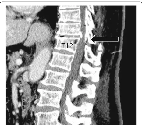 Fig. 3 One week after the operation, sagittal MRI revealed that thehyperintense region had extended to approximately the T4 level