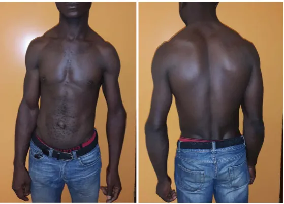 Figure 1. Clinical appearance of a neglected dislocation of the elbow with deformation