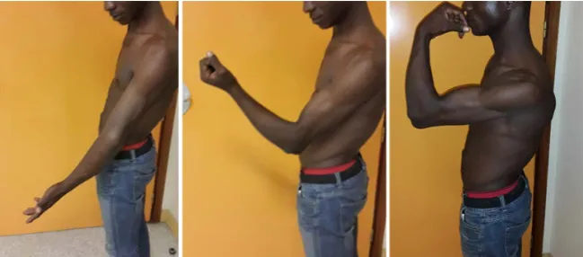 Figure 2. Radiological appearance of a neglected dislocation of the elbow. 