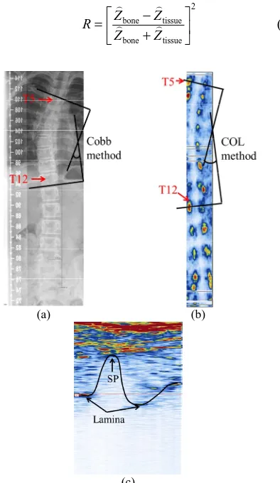 Figure 9. The spinal images of the AIS participant: ) the PA radiograph; (b) the US coronal view (170 slices); and (c) (aa transverse image of a vertebrae (single frame)