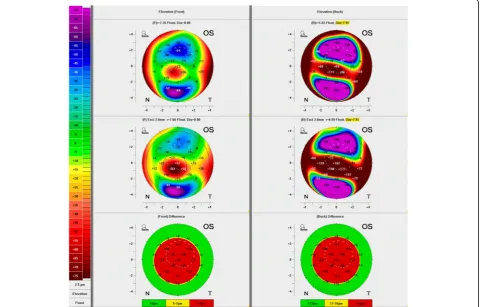 Fig. 3 Optical coherence tomography of the left eye at day of presentation (a) and at last control before keratoplasty (b) showing a cone-shapedbulge of the cornea with corneal thinning and increase of stromal hyper-reflexivity in the posterior part (arrow)
