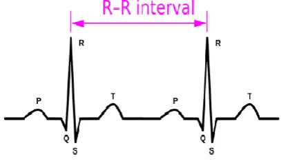 Fig 1. A typical ECG trace, with a P wave, Q, R and S waves (which form the QRS complex) and a T wave, and 