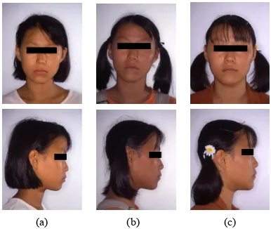 Figure 1. Facial photographs of patient 1: (a) pre- treatment; (b) posttreatment; and (c) postretention