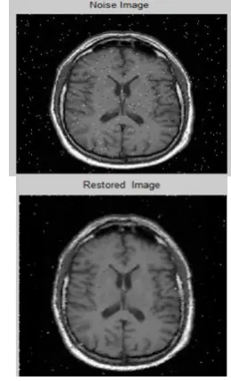Figure 1: Working of MRI Image 