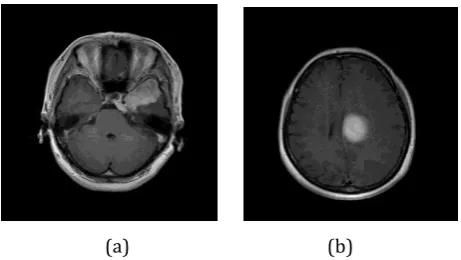 Figure 2 shows brain tumor images from the dataset. 