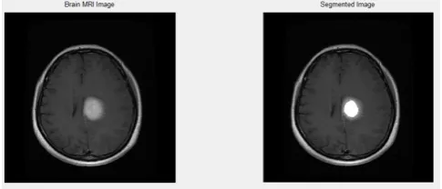 Figure 3 shows the brain tumor segmentation using 