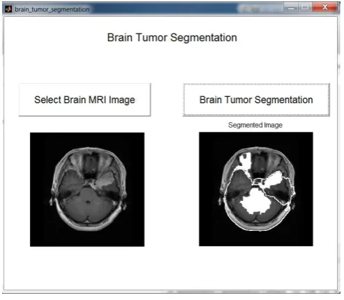 Figure 5 Brain Tumor Segmentation 