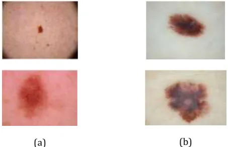 Fig 1: (a) Sample Benign image and (b) sample malignant images 