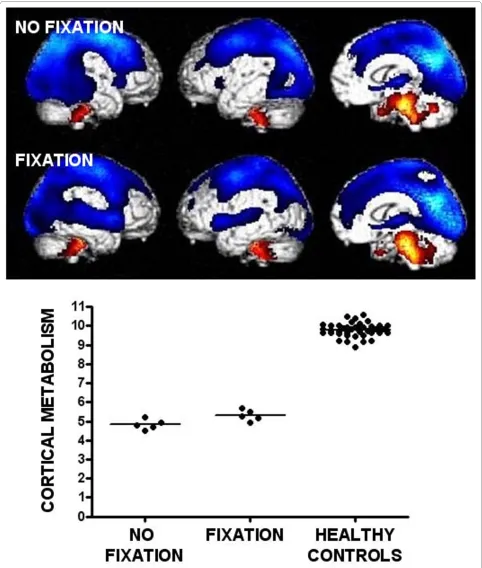 Figure 1 Brain areas with impaired cerebral glucose metabolism (blue) in patients in a vegetative state (without fixation) and in patients function (red)