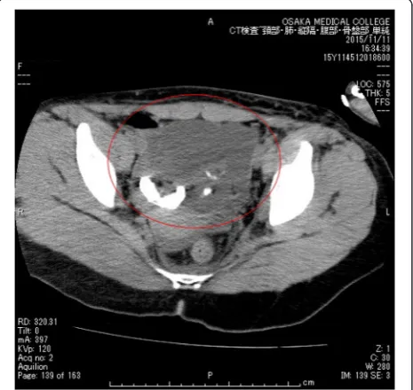 Fig. 3 Abdominal CT image showing a right cystic adnexal masswith an internal focus of fat and high-attenuation material, suggestingan ovarian teratoma (red circle)
