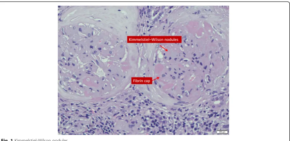 Fig. 1 Kimmelstiel-Wilson nodules