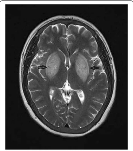 Fig. 2 Brain MRI performed upon admission. T2FLAIR showedsymmetrical hyperintense non-hemorrhagic lesions in the entirebilateral basal ganglia (arrows) and corona radiata lesions showingmild diffusion restriction