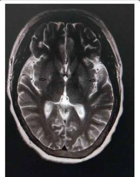 Fig. 4 Follow-up MRI scan obtained after 14 days. T2FLAIR revealedhigh signal in the bilateral basal ganglia (arrows), which weresignificantly weaker compared to the initial MRI signal