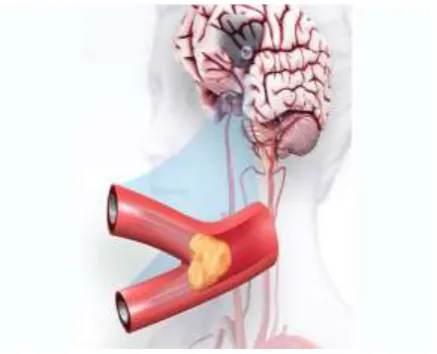 Fig -1: Supply of blood to the brain through vessel Obstructed 