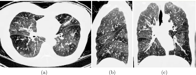 Figure 1.1: A representative thoracic HRCT image volume, displayed in 2D slices of (a)axial, (b) sagittal, and (c) coronal planes