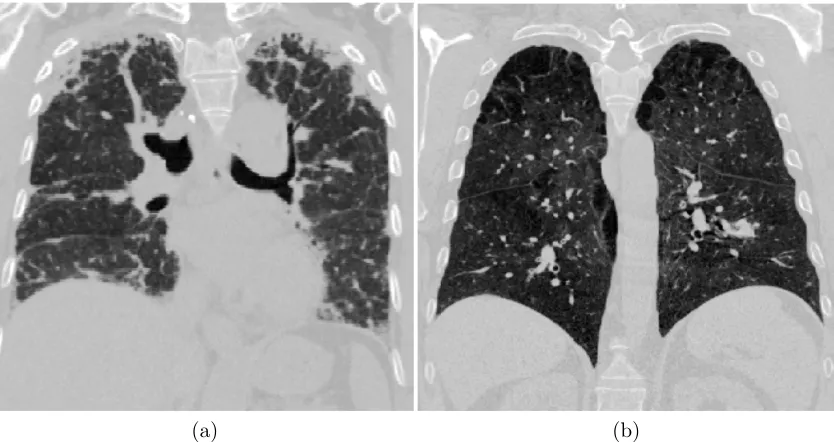 Figure 1.2: A visual comparison of CT images of (a) interstitial lung disease and (b) chronicobstructive pulmonary disease.Note the visually diﬀerent texture patterns for the twodiseases.