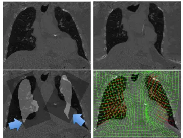 Figure 4.1: Computed tomography images of two lung lobes moving in diﬀerent directions.Top row: images before/after applying the transform