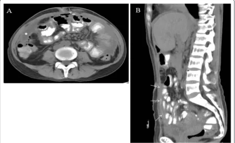 Figure 2 A and B. Repeated CT scan with patient ingesting 200 ml of UltravistW medium