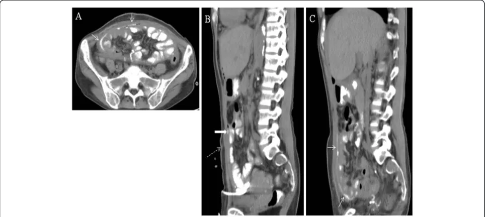 Figure 3 A, B and C. Peated CT scan when pus was completely drained and patient ingested 400 ml of UltravistW medium