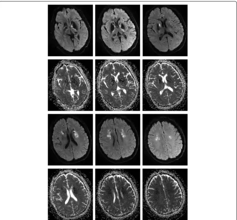 Fig. 2 Brain magnetic resonance imaging (MRI). Hyperintense signal in diffusion weighted imaging (DWI) and hypointense signal in apparentdiffusion coefficient (ADC) in bilateral basal ganglia and periventricular regions