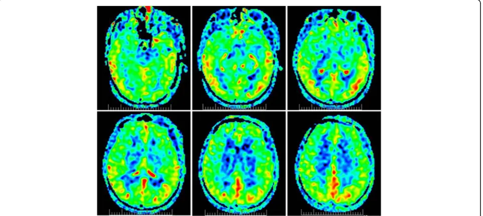 Fig. 3 Computed tomography (CT) of a daughter with brain calcification. Symmetric calcifications in bilateral basal ganglia, caudate nucleus,subcortical white matter and cerebellum
