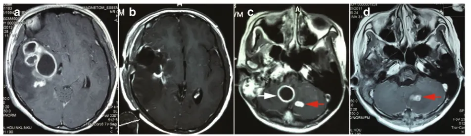 Fig. 2 Pre and post-surgical image of intracisternal tuberculoma.at right cisterna magna (white arrow)