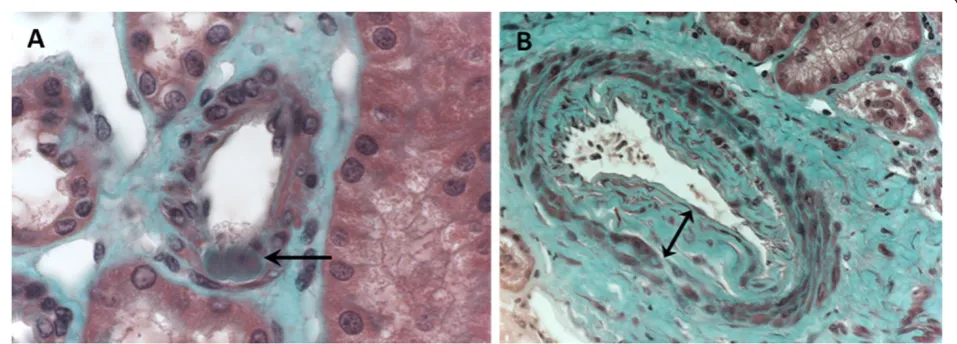 Figure 1 Vascular lesions analyzed on renal biopsy (optic microscopy, Masson’s trichromic staining)