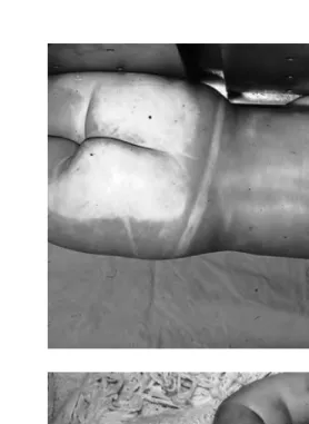 Figure 2.2 (compression of vessels by weight of body. (C) Infant with pale face from lyingcontinued) (B) Blanched areas of buttocks and shoulders due toface down in crib.