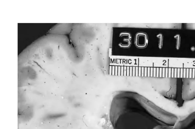 Figure 3.11 Sudden death due to unsuspected colloid cyst of third ventricle.