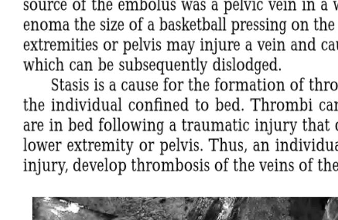 Figure 3.14 Bilateral massive pulmonary thromboemboli