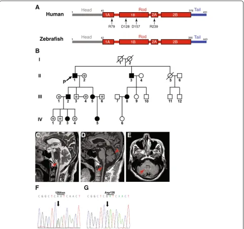 Fig. 1 Clinical features andffor aspartic acid (p.Asp128Asn).prominent atrophy in the upper cervical cord ( GFAP sequences of the proband