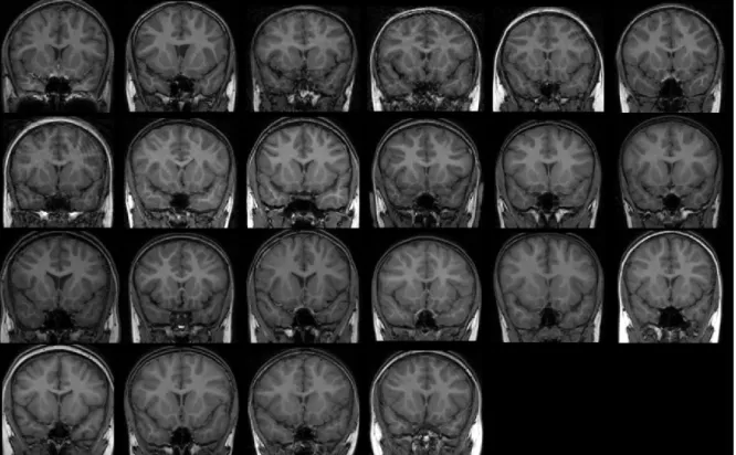 Figure 3: One coronal slice of each of the 22 healthy control MRIs that we use as a training set, where the inter-subject variability in shape and size may be observed.