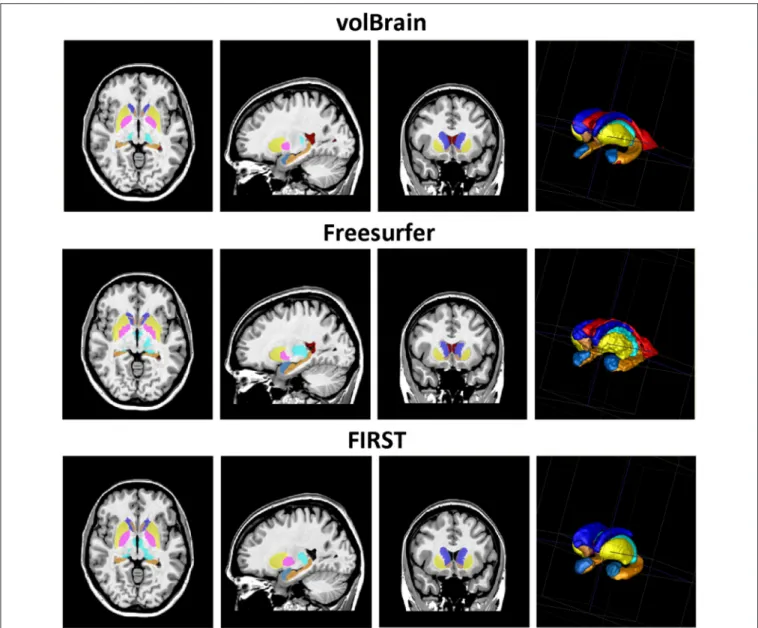 FIGURE 5 | Visual example of the segmentation results (Axial, sagittal, and coronal views and 3D representation of segmented subcortical structures).