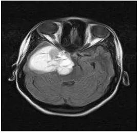 Fig 8: Threshold Segmented Image (White portion indicates tumor) 