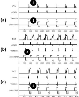 Figure 3.5: Crosstalk between pacemaker leads with high sensitivity in the ventricle, ad-justed sensitivity and ventricular safety pacing